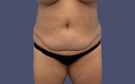 Abdominoplasty (Tummy Tuck) 10 Before